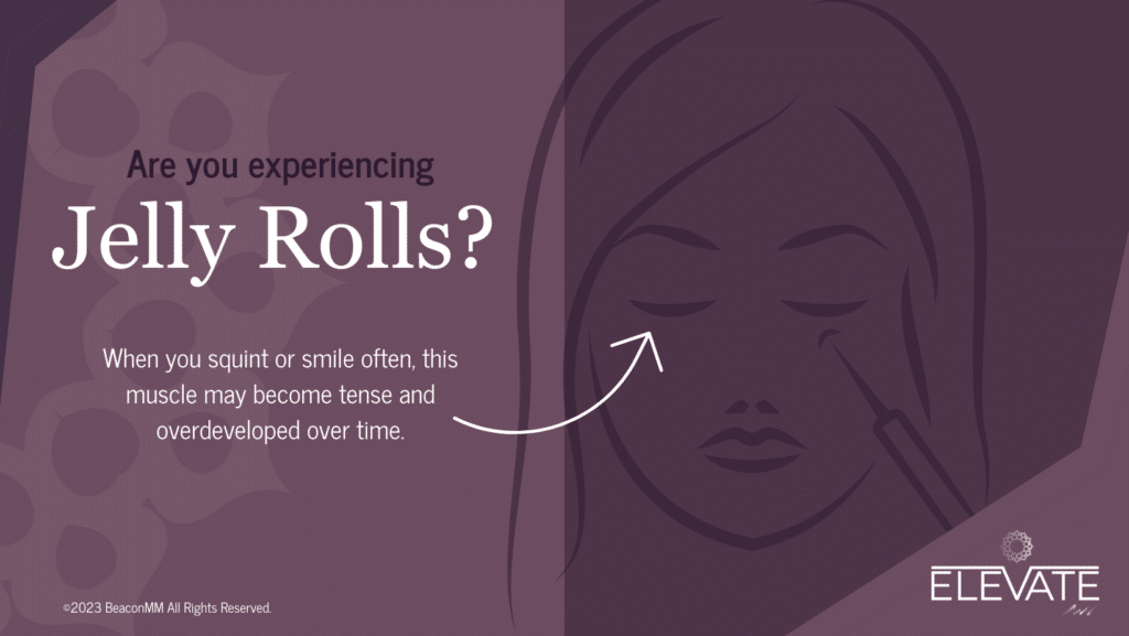How BOTOX Can Help Undereye Jelly Rolls Elevate