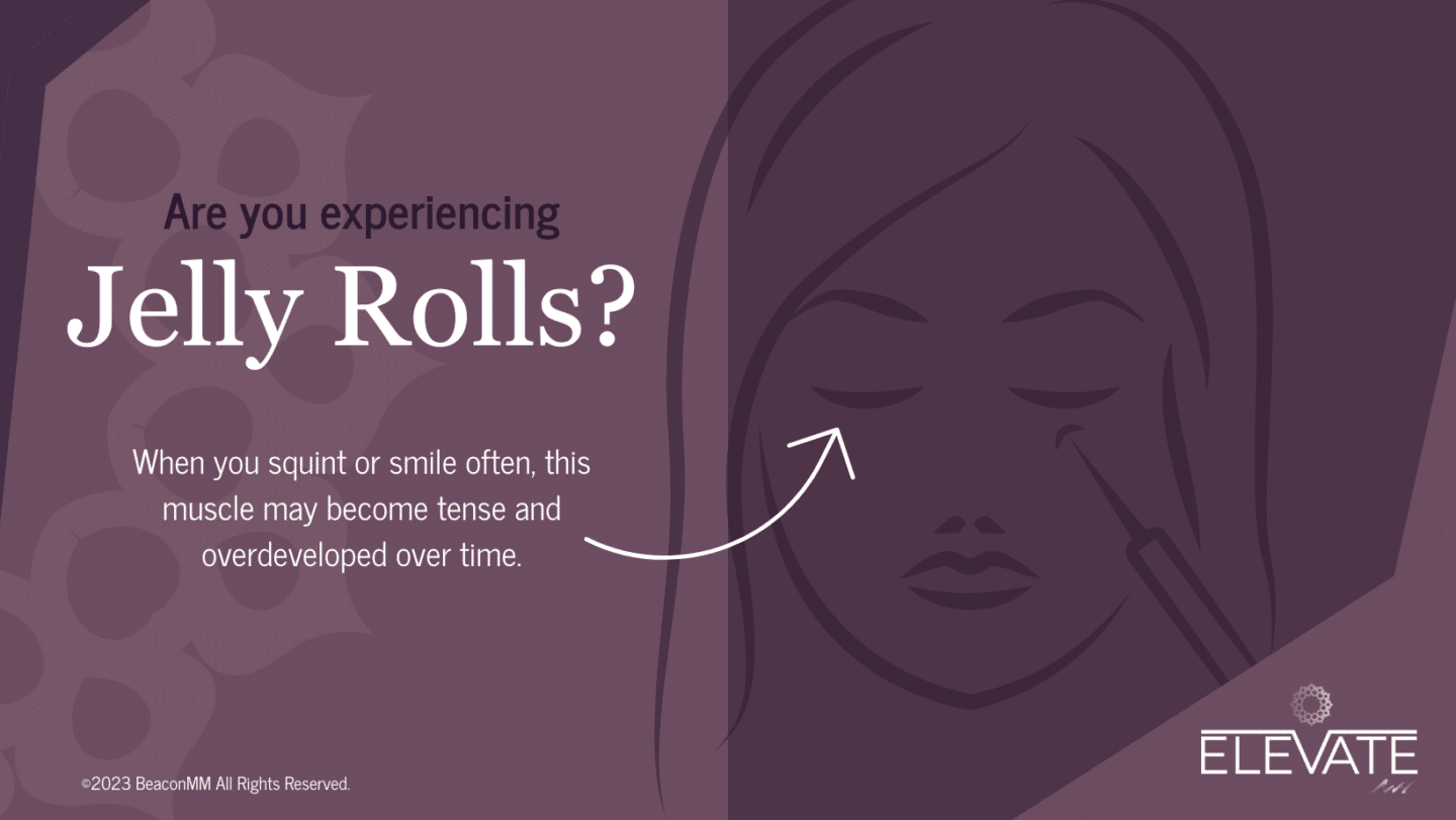 Are You Experiencing Jelly Roles? Infographic