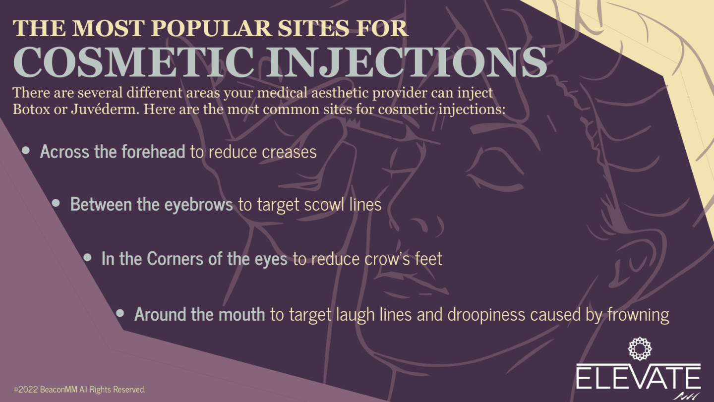 The Most Popular Sites for Cosmetic Injections Infographic