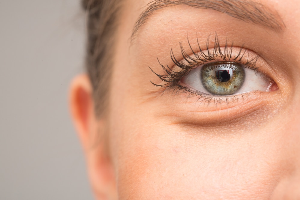 Female botox patient with under eye jelly rolls